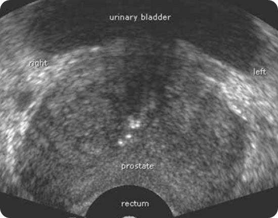 전립선 초음파