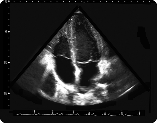 심장 초음파